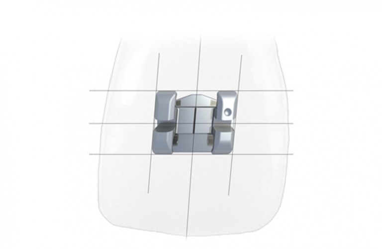 Diagonal AngulationThis patented technology keeps all horizontal visual cues parallel to the occlusal plane, and all vertical visual cues parallel to the tooth's long axis.