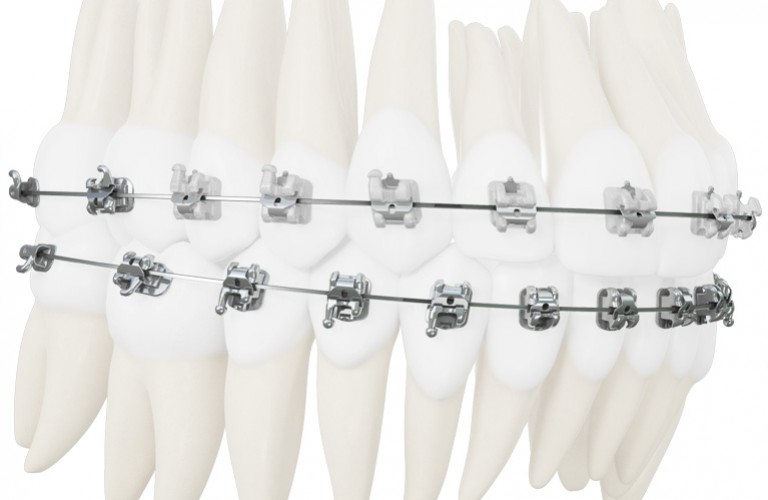 Dual Activation™ System (Combination interactive/passive system)Dual Activation combines interactive anterior brackets with passive posteriors for a hybrid system that minimizes ligation forces, while still offering full anterior control for precise finishing.Anterior teeth – Interactive brackets. Low ligation force during initial leveling and alignment; exceptional torque and rotation control during finishing.Posterior teeth – Passive brackets. Low ligation forces throughout all stages of treatment.